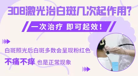 白癜风308激光照几次能好