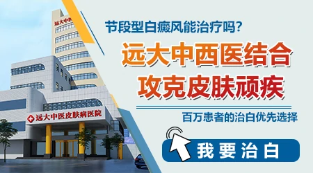 节段型白癜风好不好治疗 怎么治好