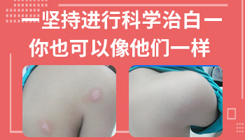 肛门有白癜风能治好 怎么治