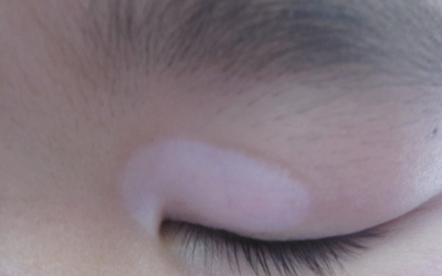 孩子眼角处有一个指甲盖大的白斑是什么