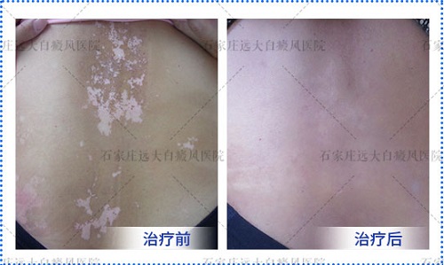 中药液可以治疗白癜风吗