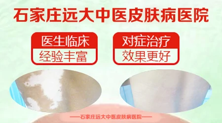 普通白斑和白癜风在wood灯下的区别图