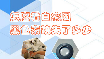 白癜风黑色素缺失怎么造成的 能治好吗