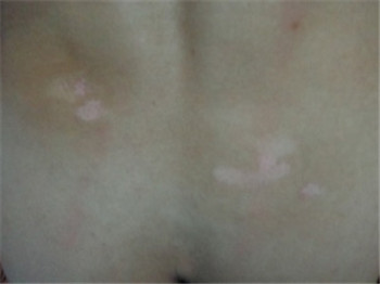 孩子身上长很小很小的白色斑点怎么回事