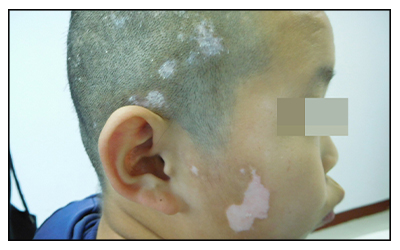 白癜风的发病年龄是多大 小孩会得白癜风吗