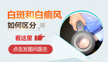怎么区分白癜风和白疤