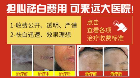 看白癜风花多少钱