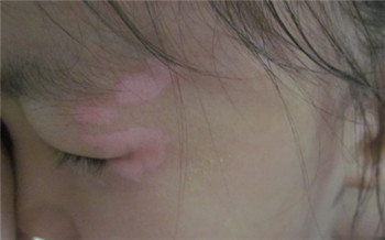 白癜风的图片是什么样子