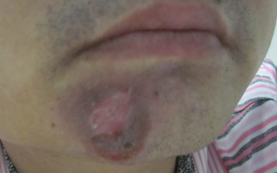 下巴长了一点白斑不明显一月了怎么治