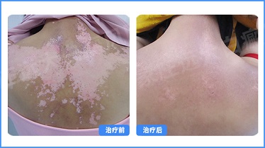 白斑怎么治才能根除