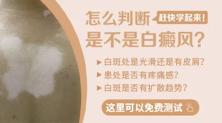 怎么测试自己身上白斑是不是白癜风