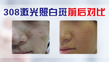 面部白癜风治疗多久有好转