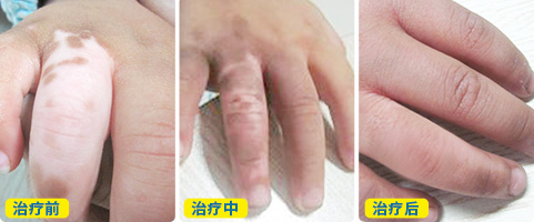 手指白癜风光疗的效果图