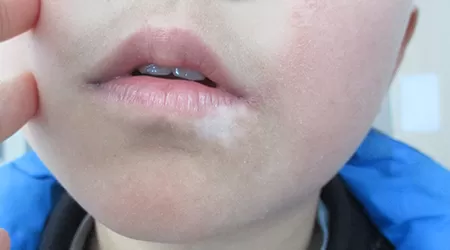 嘴唇白癜风的初期图