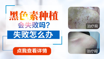手术治疗白癜风一定能成功吗 万一失败了怎么办