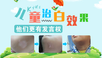 怎么区分孩子白斑是什么 不同病症白斑的图片