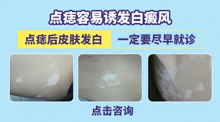 点痣后皮肤变白变成白癜风了怎么办