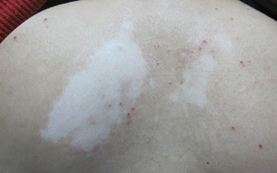 孩子背上的白癜风四年能治好吗