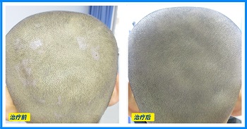 三岁小孩头上有白斑能治好吗