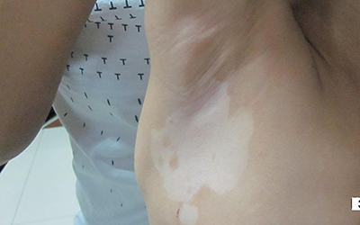 宝宝身上有小白点图片