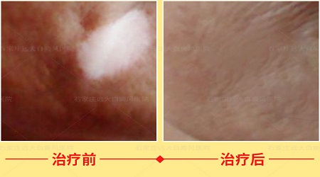 肚脐周围白了一片是白癜风吗