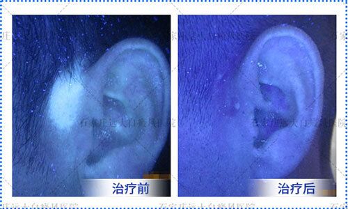 伍德灯照白斑照的是皮肤基底层吗