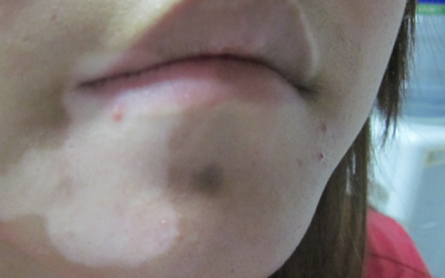 嘴上白癜风的早期症状图片