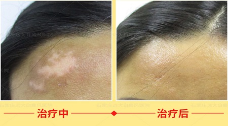 白癜风影响军队文职体检吗