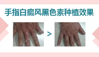 手指白癜风种植几率高不高 手指白斑治好案例