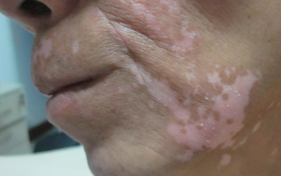 脸颊中间有瓷白色的白癜风两个月了