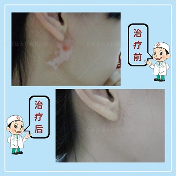 小孩耳朵后边白斑半年了是什么 白斑随着时间增多