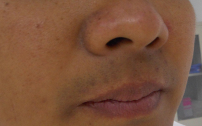 嘴唇边上有白斑图片