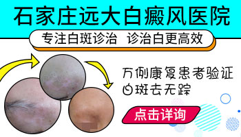 全国治白癜风排名前十的医院