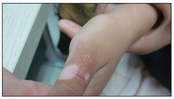 儿童手指关节出现白斑图片