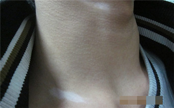 小孩脖子白斑早期症状图片