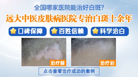 河北石家庄周边哪个医院治疗白癜风有名