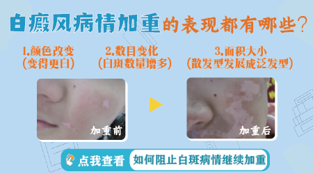 手指发展期白癜风越来越明显怎么治