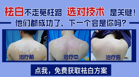 白癜风属于不治之症吗