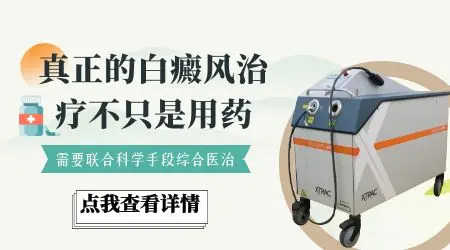 白癜风治疗