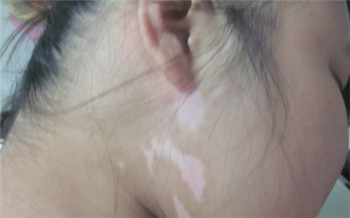 青少年脸上有淡淡的白斑图片