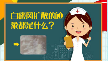 白斑边缘不规则是白癜风扩散了吗