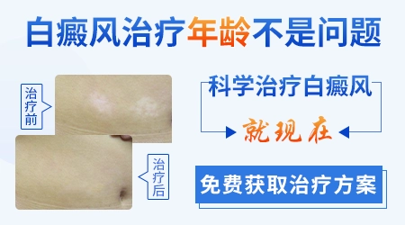 儿童白癜风ZUI佳治疗年龄是几岁