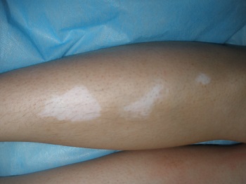 小腿白斑早期的症状图片