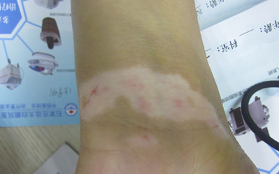 手腕处长白癜风能做黑色素移植吗