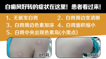 检查白斑好转经常照伍德灯有危害吗