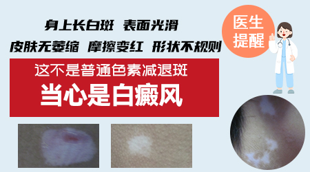 皮肤白斑白点光滑不痛不痒 小心得了这种皮肤病