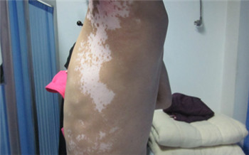 白癜风的症状图片是什么样的 【不同类型白斑图】