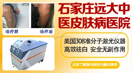 邢台哪家医院皮肤科专门看白癜风