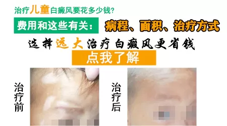 儿童白癜风去邢台哪个医院