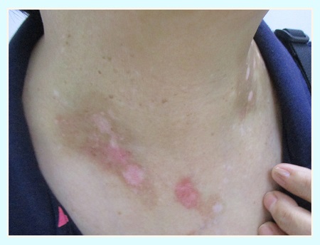 脖子上白色斑块的图片